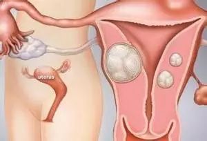 子宫肌瘤艾灸哪个部位,艾灸子宫肌瘤