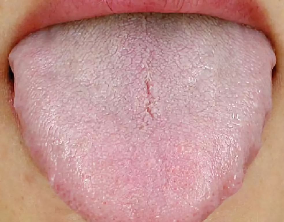 舌头有齿痕是怎么回事