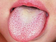 舌苔白腻厚是什么原因?寒湿体质艾灸这样配穴！