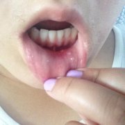 <b>口颊溃烂艾灸的方法和穴位</b>