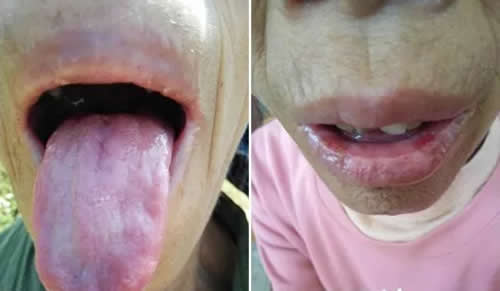 口唇湿烂艾灸的正确方法和穴位