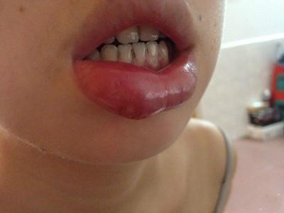 口疮的艾灸穴位及治疗方法