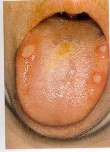 舌疮的艾灸穴位及调理方法