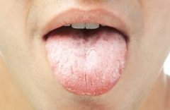 舌裂艾灸穴位及治疗的方法