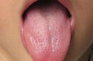 舌麻的艾灸穴位及治疗方法
