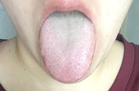 舌强