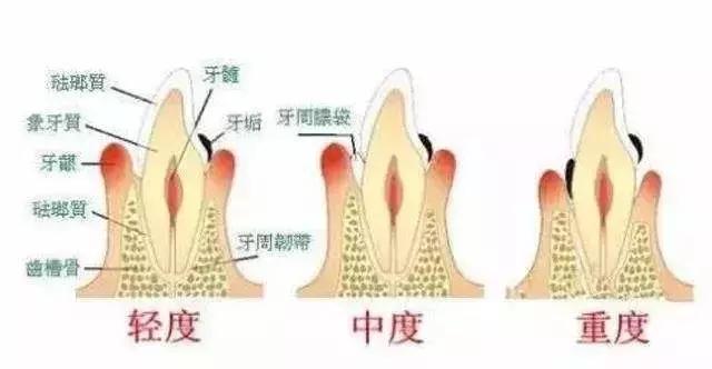 牙龈萎缩艾灸穴位及调理方法