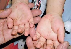 手足口病症状,婴幼儿手足口病艾灸的穴位