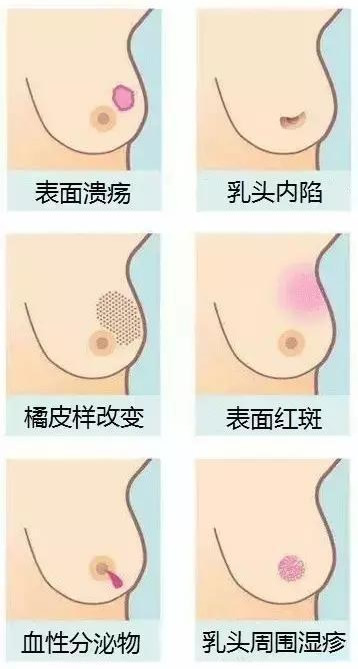 乳腺癌征象图